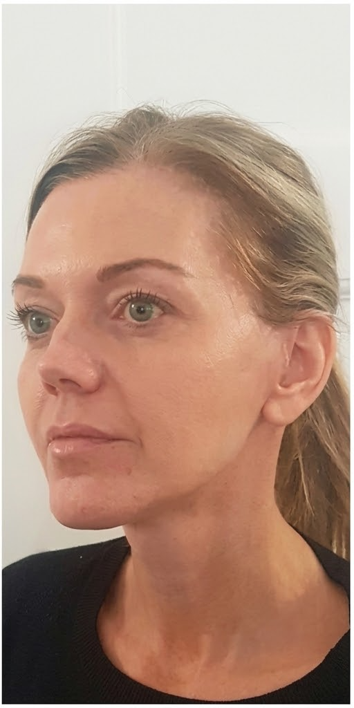 After &mdash; SMAS Face Lift in Mexico City, Argaman Plastic Surgeries Mexico